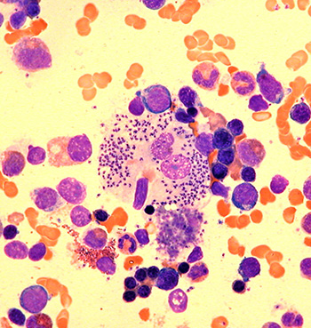 view of parasitized macrophage in bone marrow